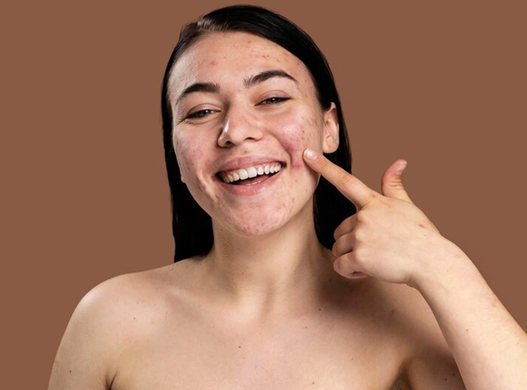 Acne Scar Treatment