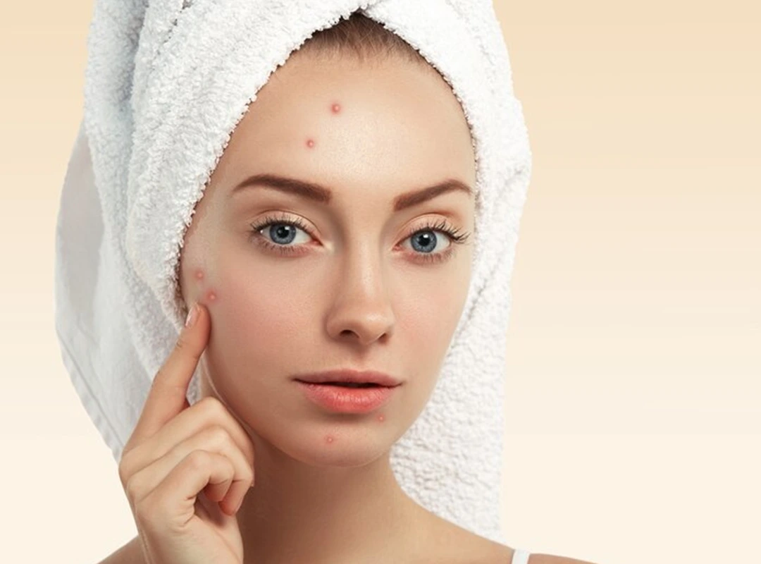 Acne Treatment