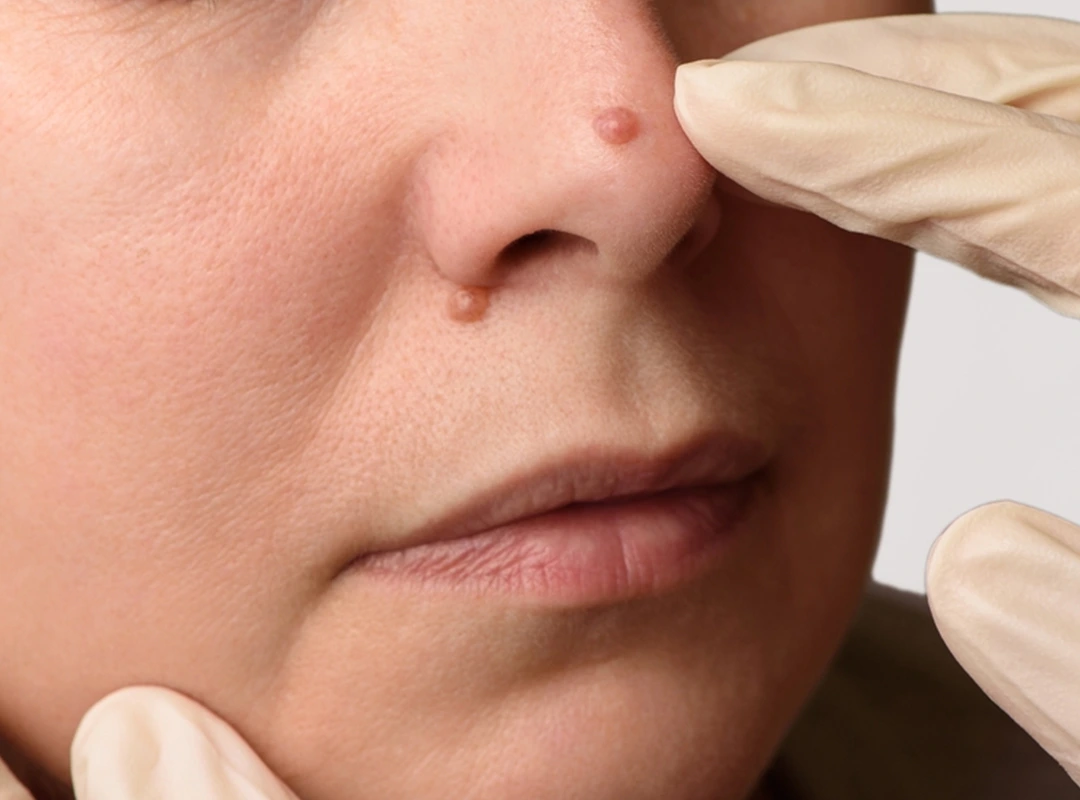 Mole And Wart Removal
